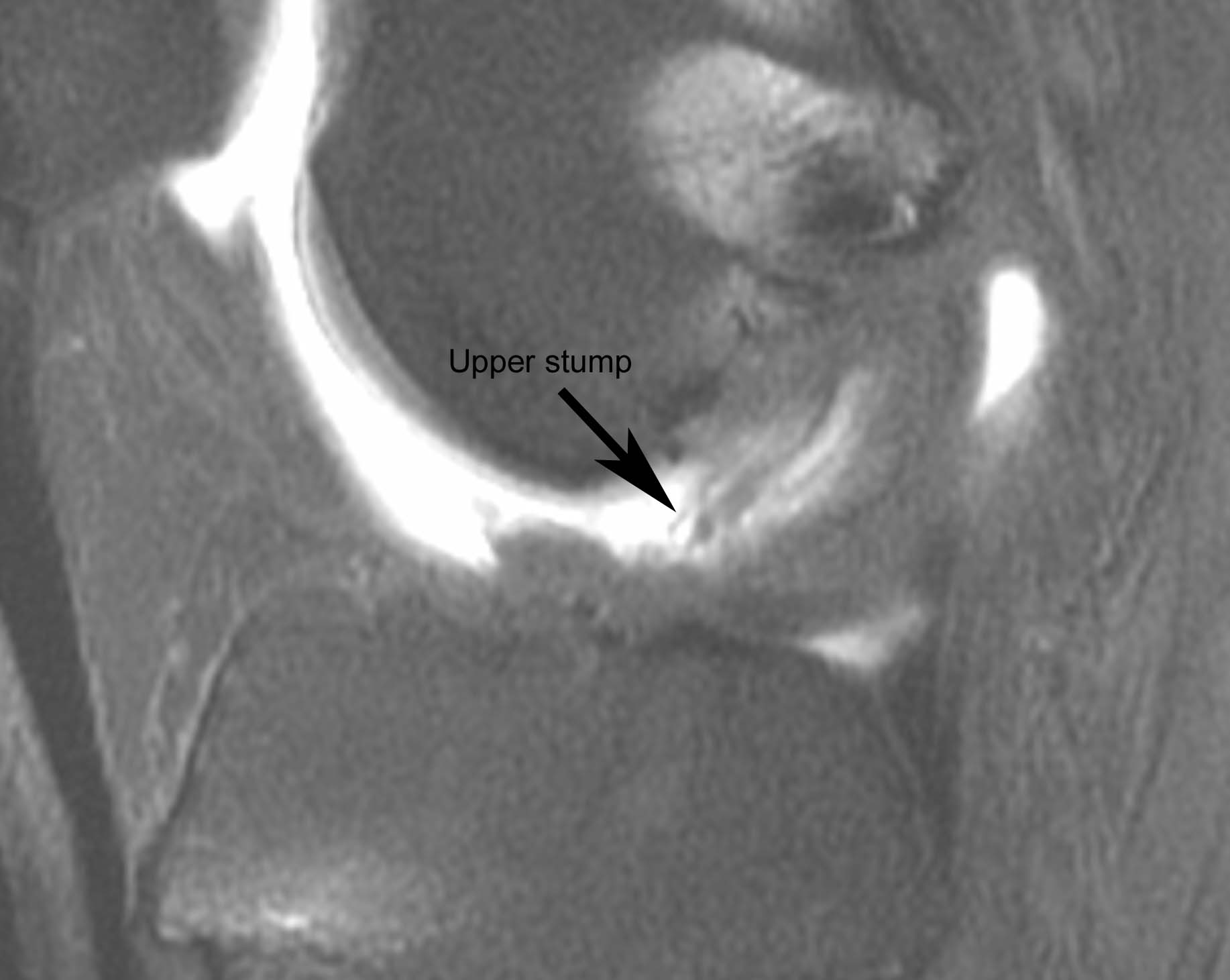 Figure 4 for case Disrupted ACL graft